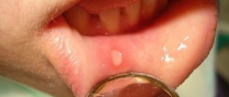 Aphtha on the lip with stomatitis