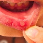 What does aphthous stomatitis look like?