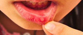 What does aphthous stomatitis look like?