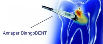 DiangoDENT device