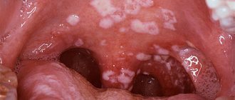 White spots on the palate of a child - causes and treatment
