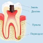 Боль при надавливании как признак периодонтита