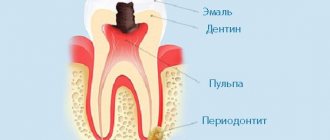 Pain when pressing as a sign of periodontitis