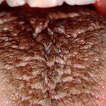 black hairy tongue disease