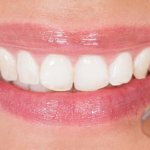 Gum disease under dentures