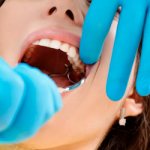 Gum pain after tooth extraction - Line of Smile Dentistry
