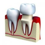 What is the difference between stamped dental crowns and cast ones?