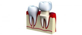 What is the difference between stamped dental crowns and cast ones?