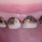 Teeth turn black near the gums