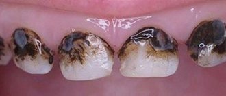 Teeth turn black near the gums