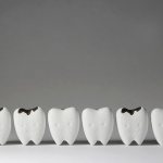 Black plaque on teeth - reasons and ways to remove it