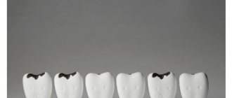 Black plaque on teeth - reasons and ways to remove it