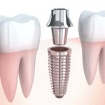 Что лучше - имплант или зубной протез