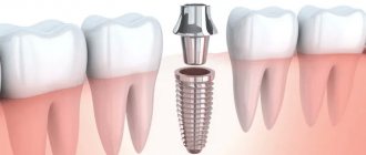 Which is better - an implant or a denture?