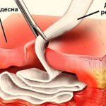 What is gum drainage in dentistry?