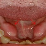что такое экзостозы после удаления зуба на десне
