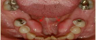 what is exostosis after tooth extraction on the gum