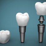 What is dental implantation