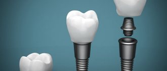 What is dental implantation