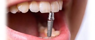 what are implants in dentistry photo