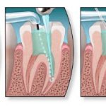 depophoresis in dentistry