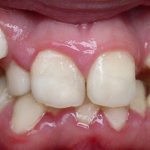 Dystopia and tooth retention