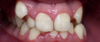 Dystopia and tooth retention