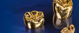 Why is gold used in dentistry? Dental crowns - what are they? 