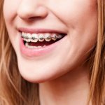 Why do you need elastic bands on braces: why they are used, how to wear them, as well as types of elastic fasteners and rules for wearing them