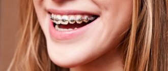 Why do you need elastic bands on braces: why they are used, how to wear them, as well as types of elastic fasteners and rules for wearing them