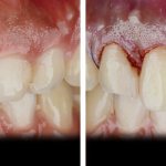 Before and after surgical gum correction