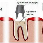 Advantages and disadvantages of dental crowns