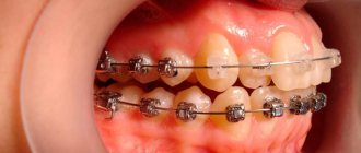 Brushes for braces