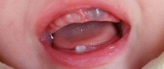 Если причиной синевы стал проростающий зуб, то симптомы могут рассосаться самостоятельно