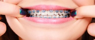 Stages of corrective therapy with braces