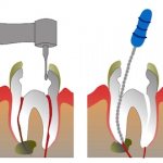 stages of periodontitis treatment