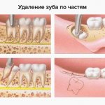 Этапы удаления зуба по частям в картинках