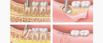 Этапы удаления зуба по частям в картинках