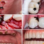 Photos before and after dental implantation in the lateral part of the chewing teeth, in the area of ​​the front teeth and with complete edentia