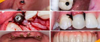 Photos before and after dental implantation in the lateral part of the chewing teeth, in the area of ​​the front teeth and with complete edentia