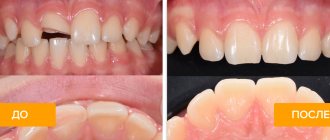 Фото до и после реставрации травмированного зуба