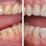 Photos before and after installation of metal-ceramic crowns