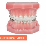 Фото керамических брекетов на зубах от компании Ormco