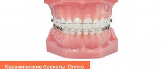 Фото керамических брекетов на зубах от компании Ormco