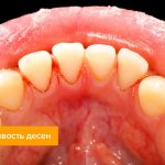 Photo of bleeding gums