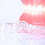 Photo of dental overlays to correct the bite