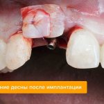 Photo of gum extension after implantation