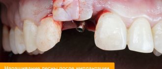 Photo of gum extension after implantation