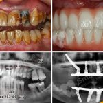 Photo of the patient before and after Zygoma and Zygomatic implantation