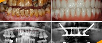 Photo of the patient before and after Zygoma and Zygomatic implantation